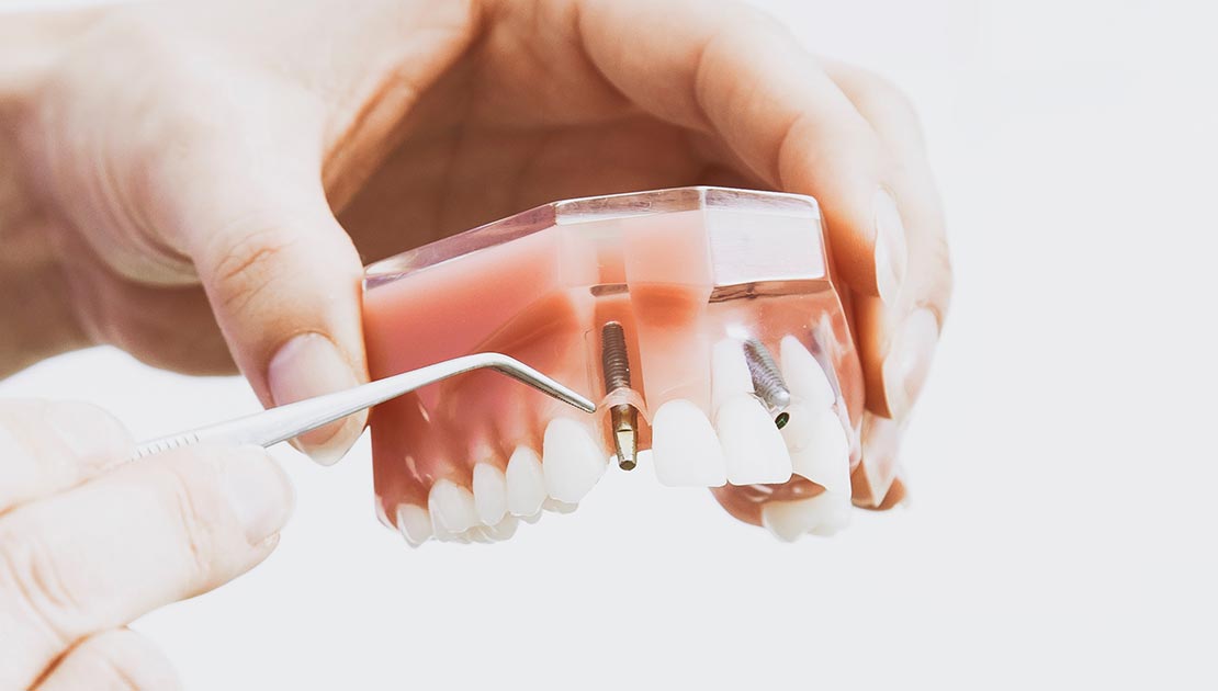 Implantes Dentários: Uma solução eficiente para a perda de dentes