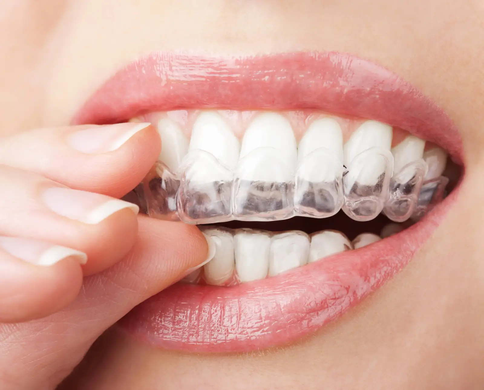 Os Benefícios do Clareamento Dental para sua Autoestima