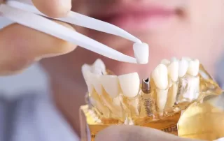 tipos de implante dentario scaled 1