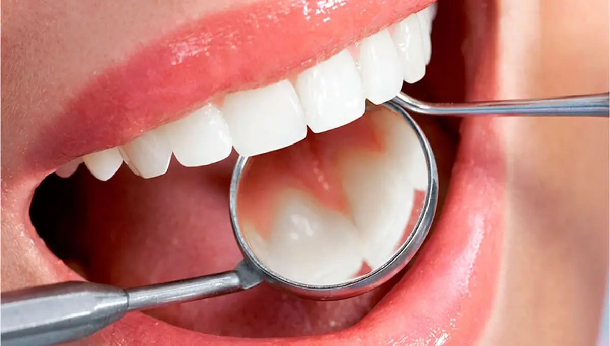 Periodontia: Cuide das gengivas e proteja seus dentes